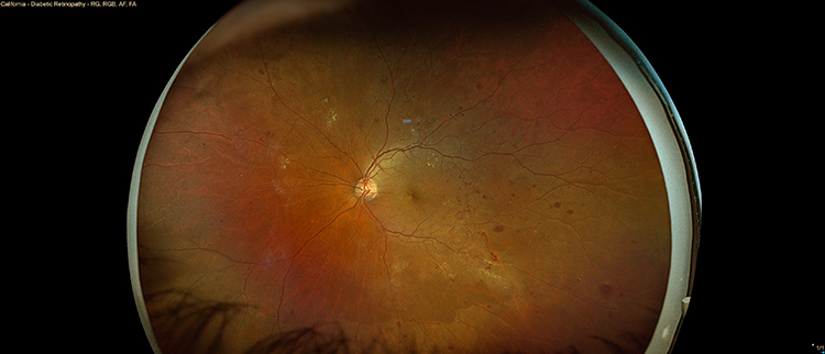 増殖糖尿病網膜症