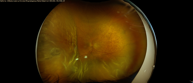 裂孔原性網膜剥離
