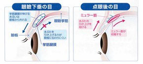 眼瞼下垂の点眼治療画像
